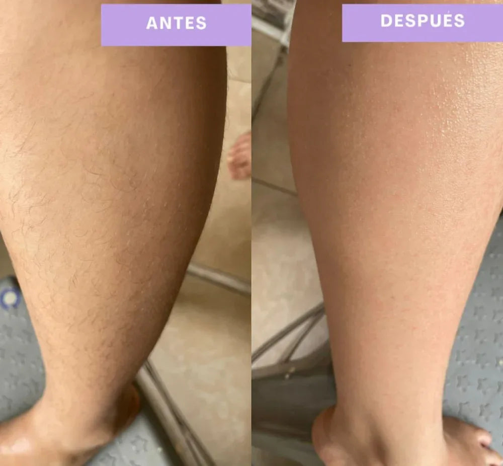 Depiladora Láser: Piel suave y libre de vellos todos los días 🌺