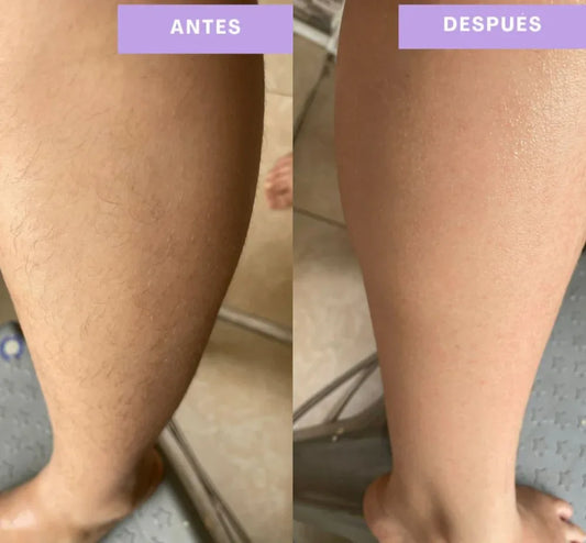 Depiladora Láser: Piel suave y libre de vellos todos los días 🌺